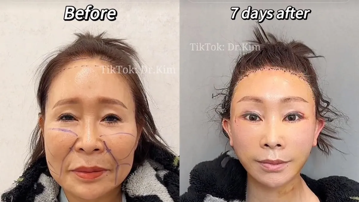 TikTok's Dr. Kim Goes Viral For Botched Plastic Surgery Results